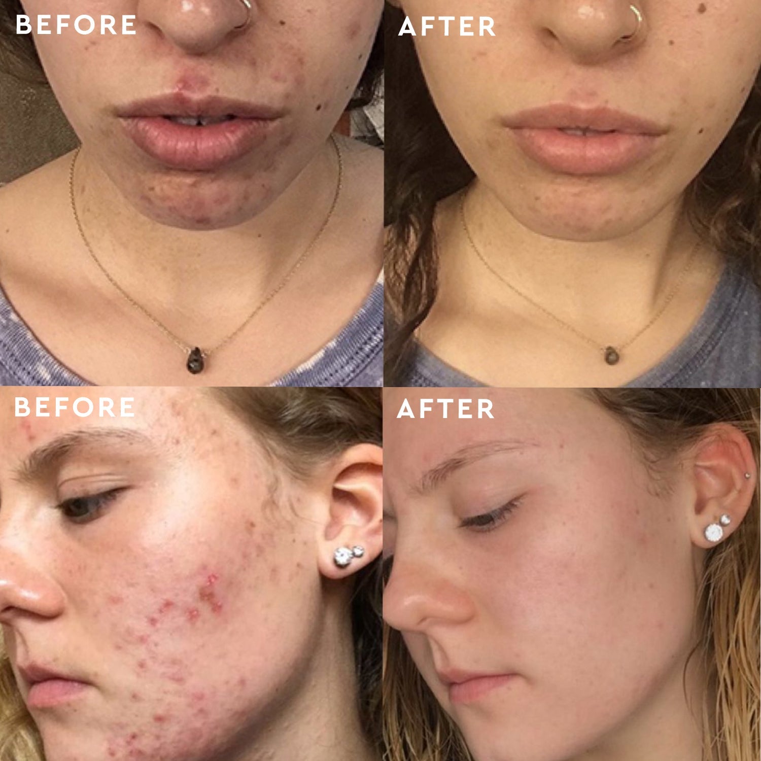 Clear Skin Routine for Teens